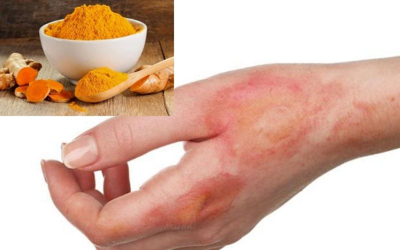 Treat the Burned wound with natural herbs at home