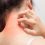 What Are Symptoms Of Cashew Nuts Allergy 1